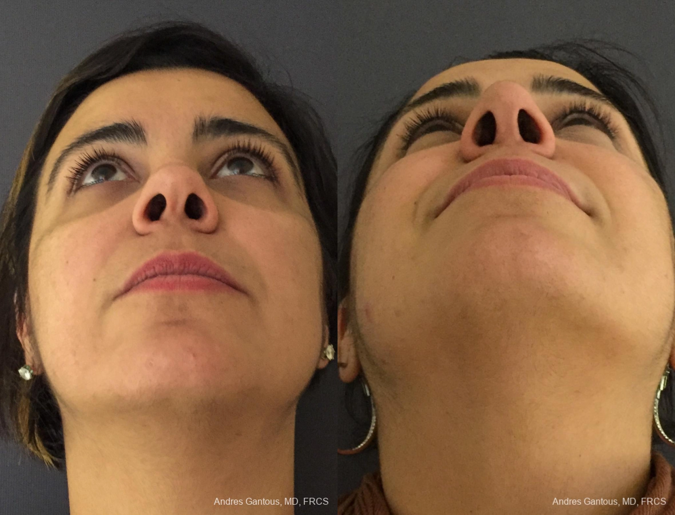 Reconstructive Rhinoplasty - Thumbnail 4