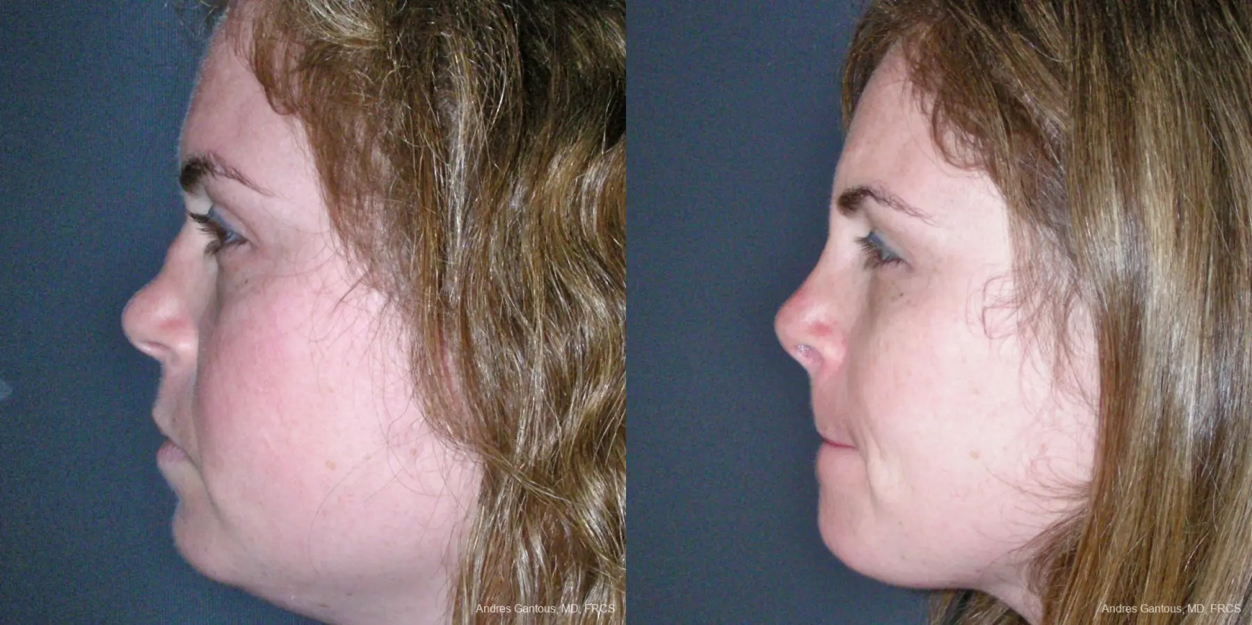 Reconstructive Rhinoplasty: Patient 4 - Before and After 5