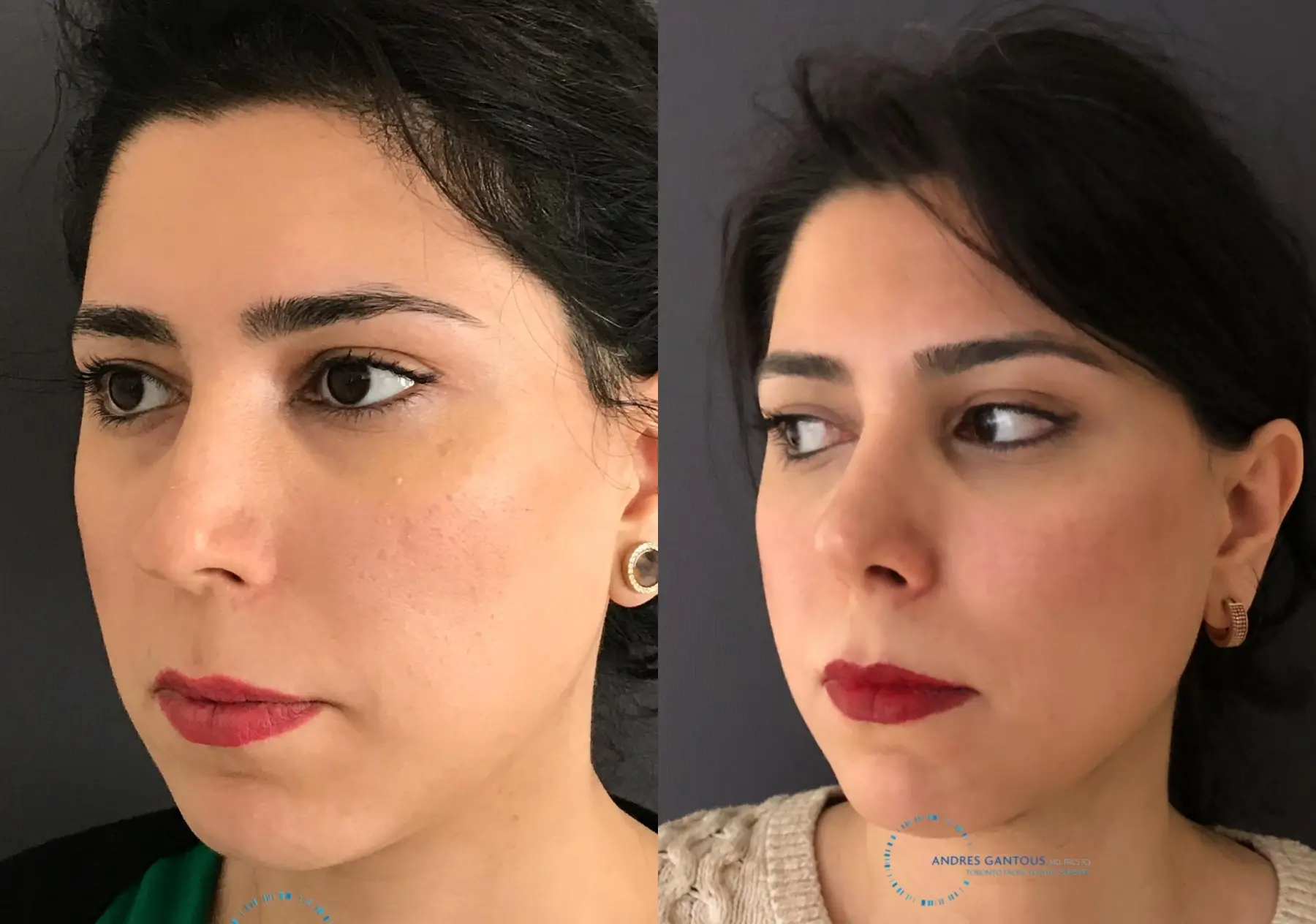 Revision Rhinoplasty: Patient 18 - Before and After 3
