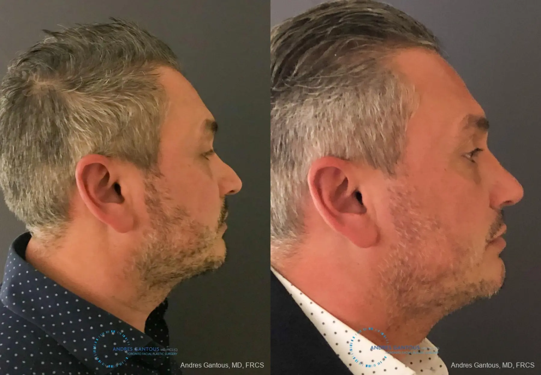 Revision Rhinoplasty: Patient 7 - Before and After 6