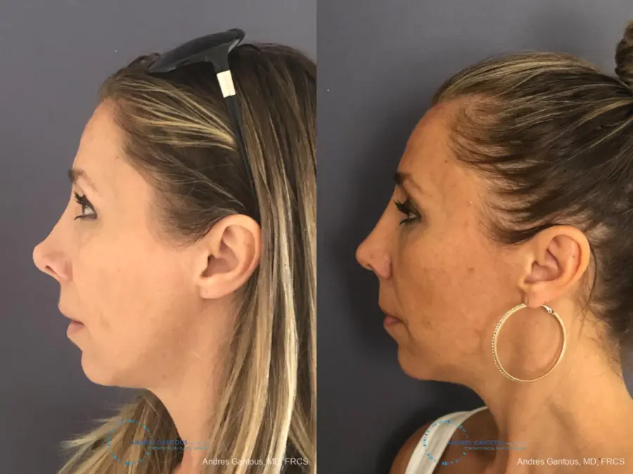 Revision Rhinoplasty: Patient 3 - Before and After 6