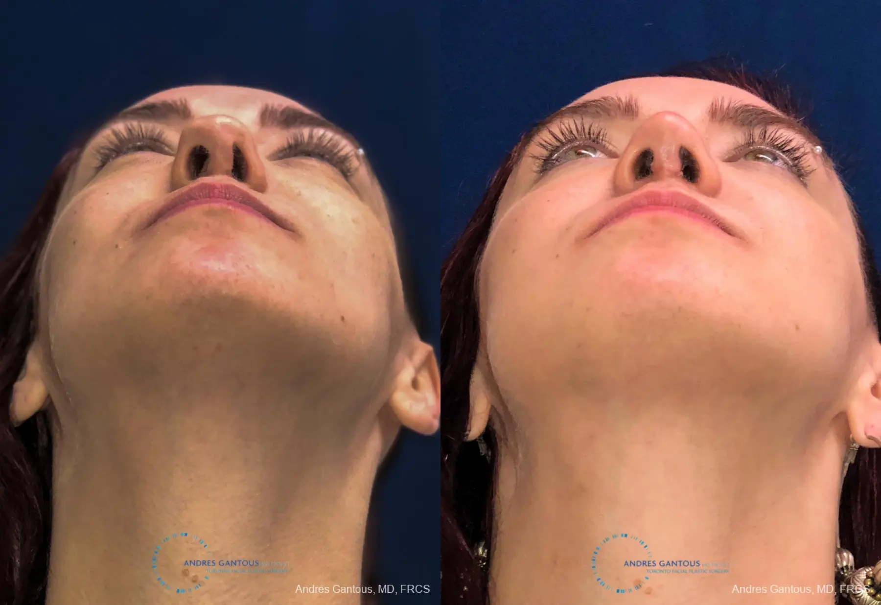 Revision Rhinoplasty: Patient 10 - Before and After 2
