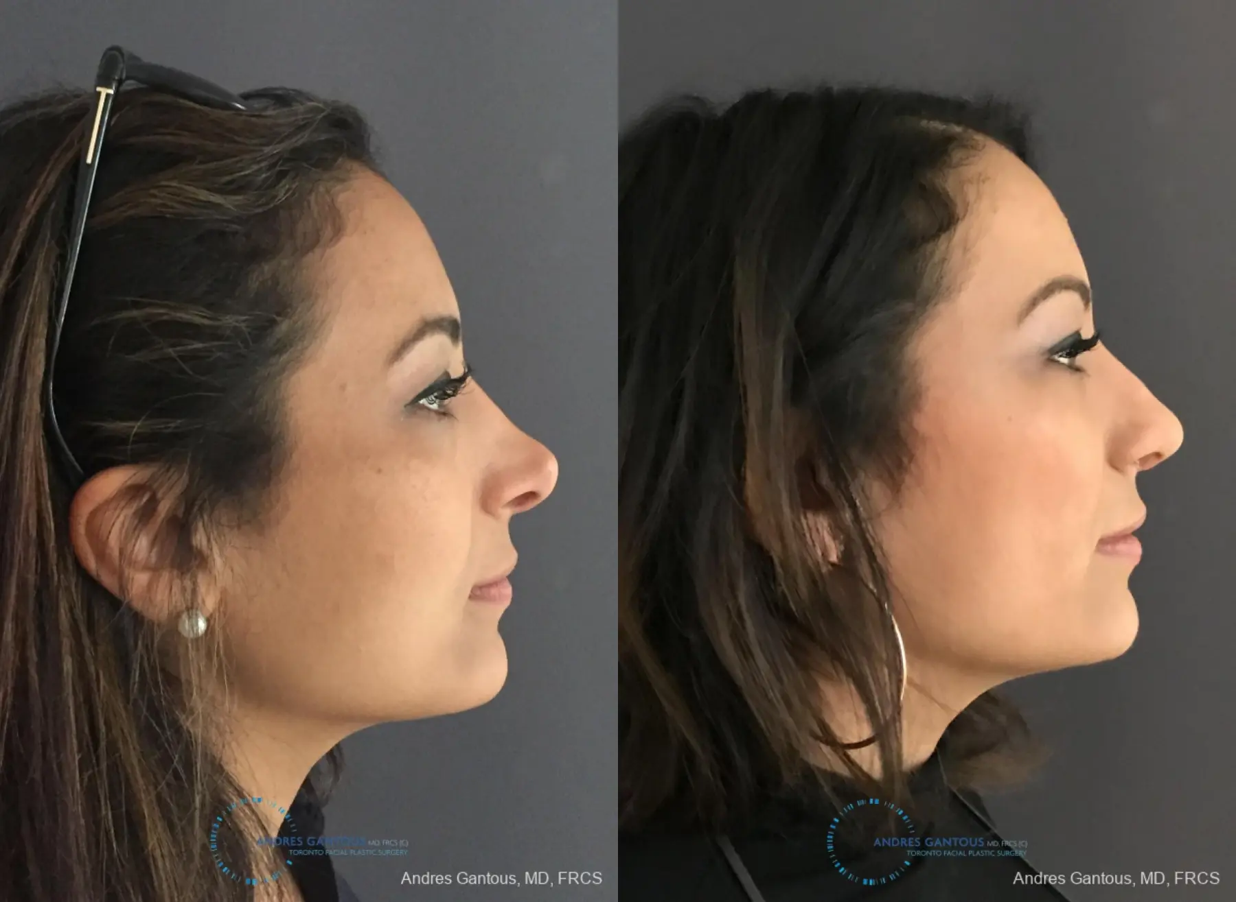 Revision Rhinoplasty: Patient 11 - Before and After 5