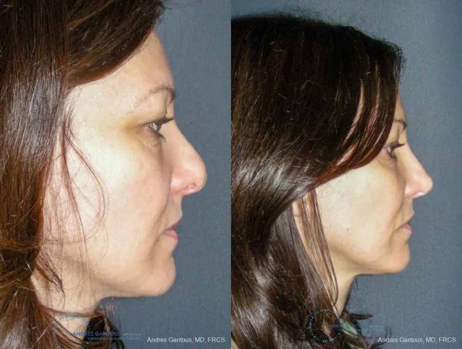 Revision Rhinoplasty: Patient 14 - Before and After 5