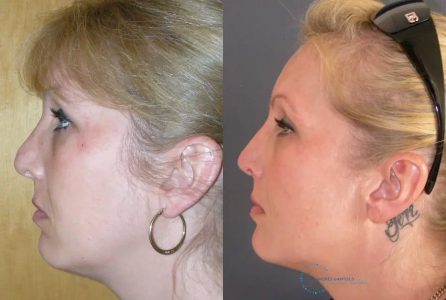Revision Rhinoplasty: Patient 16 - Before and After 6