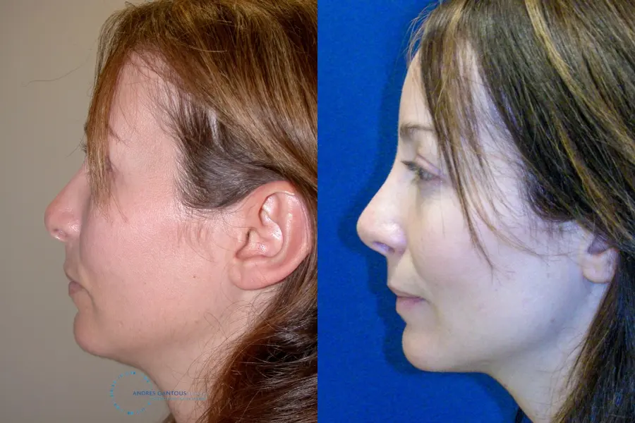 Revision Rhinoplasty: Patient 2 - Before and After 5