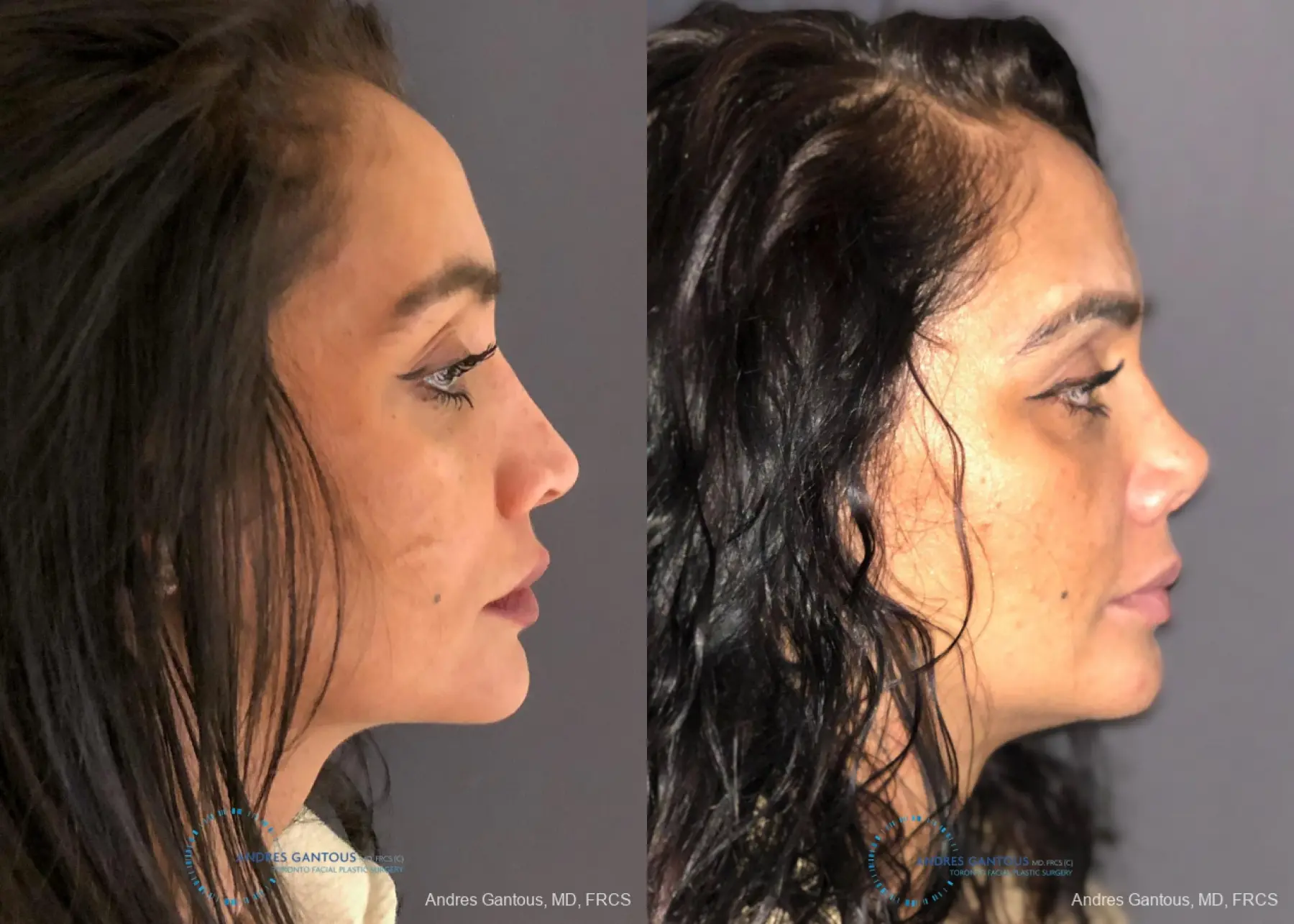 Revision Rhinoplasty: Patient 13 - Before and After 5