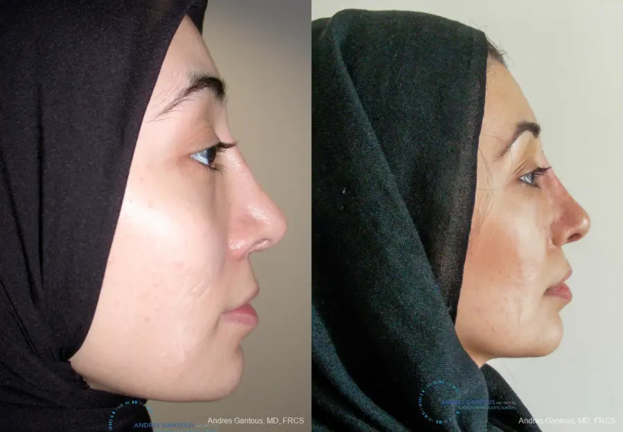 Revision Rhinoplasty: Patient 5 - Before and After 5