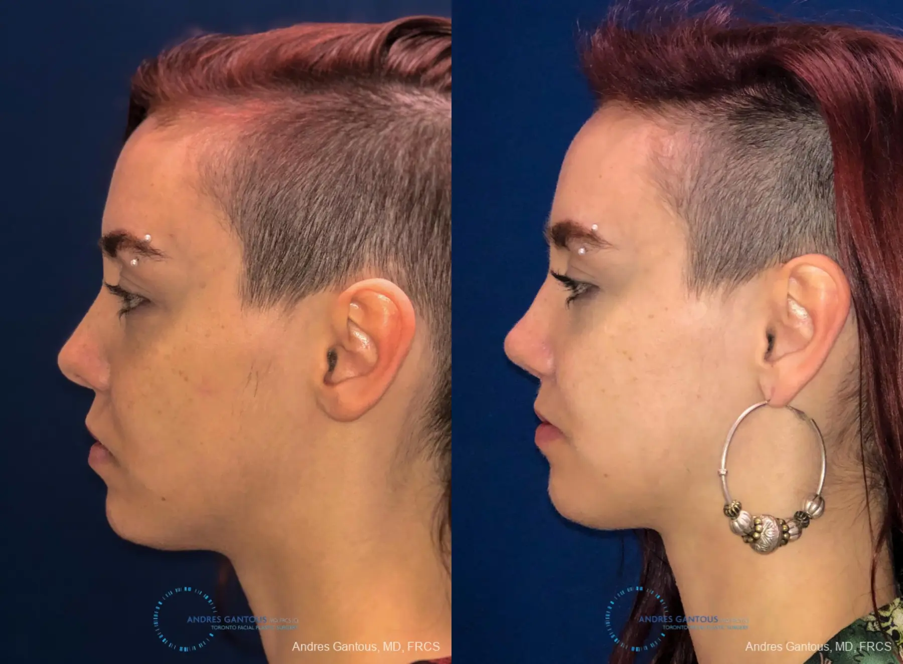 Revision Rhinoplasty: Patient 10 - Before and After 5