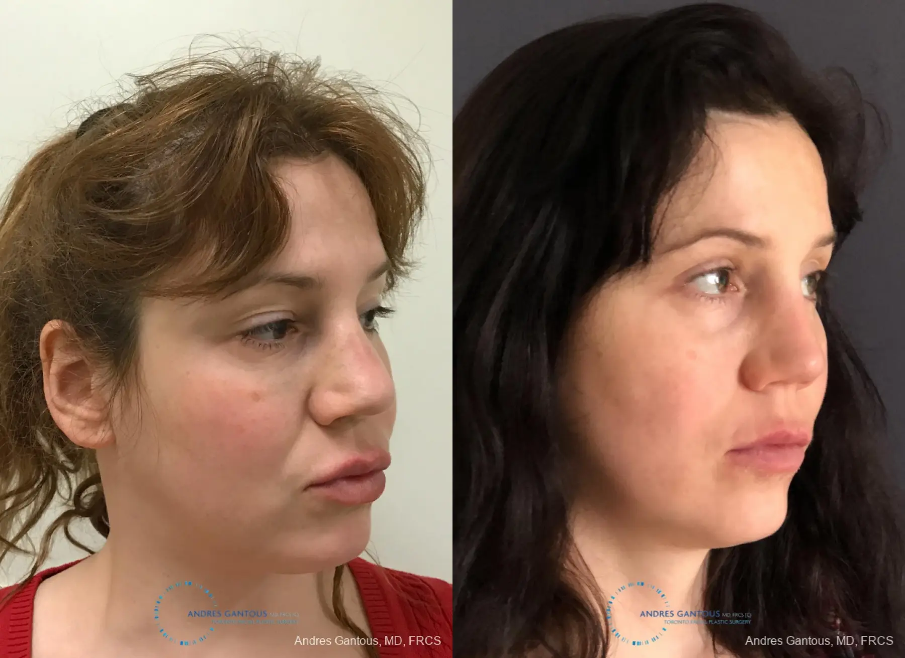 Revision Rhinoplasty: Patient 9 - Before and After 3