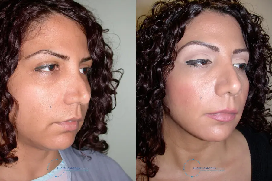 Revision Rhinoplasty: Patient 12 - Before and After 3