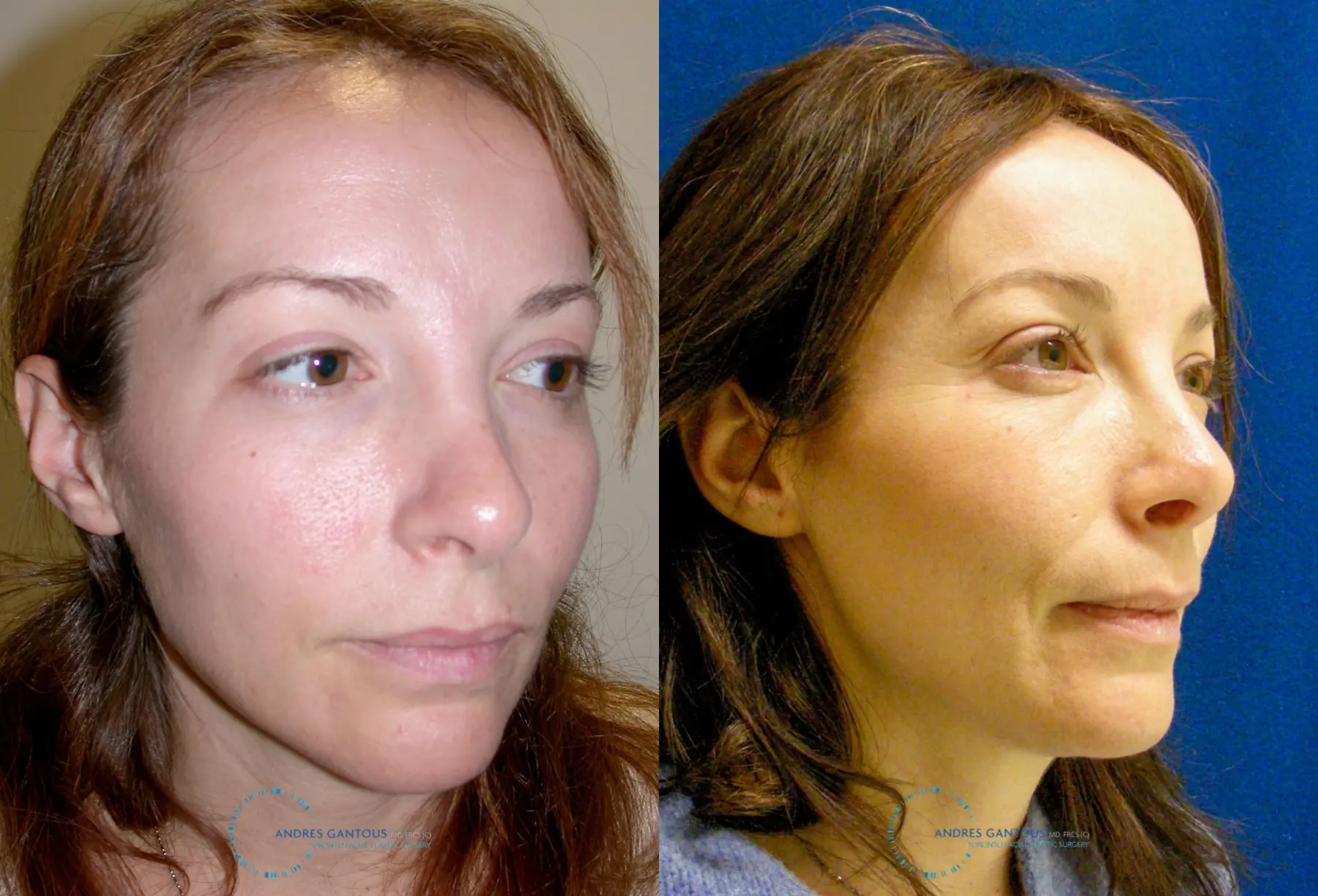 Revision Rhinoplasty: Patient 2 - Before and After 2