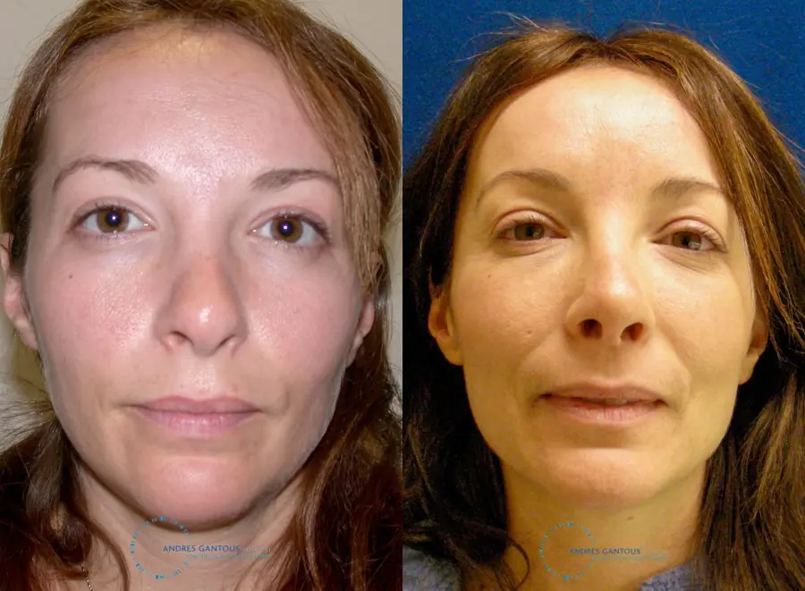 Revision Rhinoplasty: Patient 2 - Before and After 1