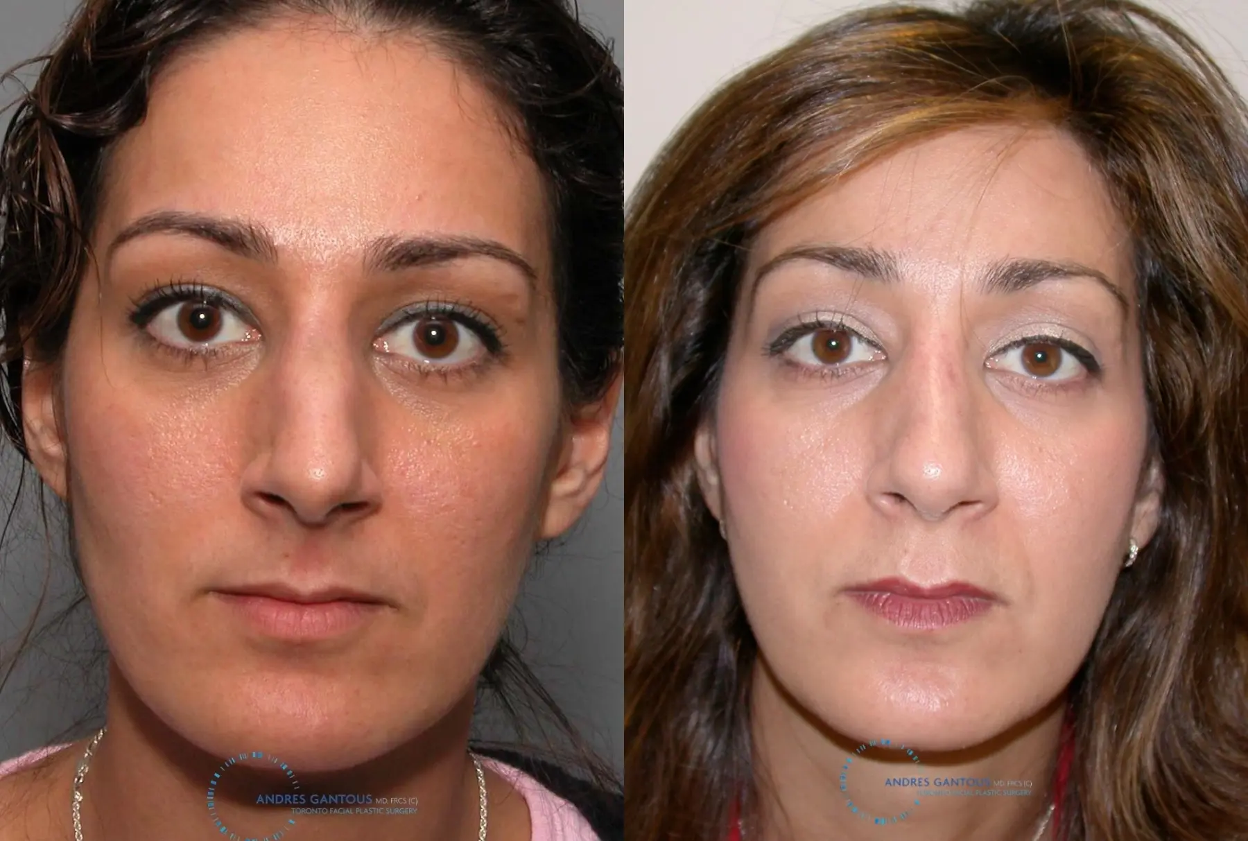 Revision Rhinoplasty: Patient 17 - Before and After 1