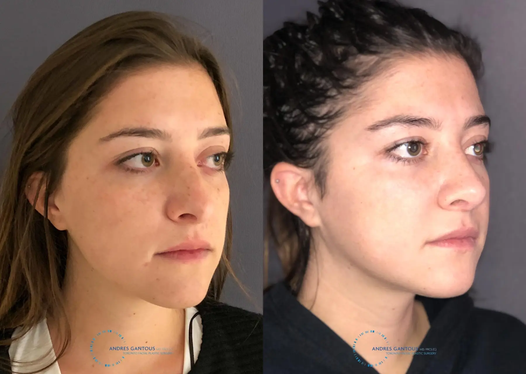 Revision Rhinoplasty: Patient 21 - Before and After 4