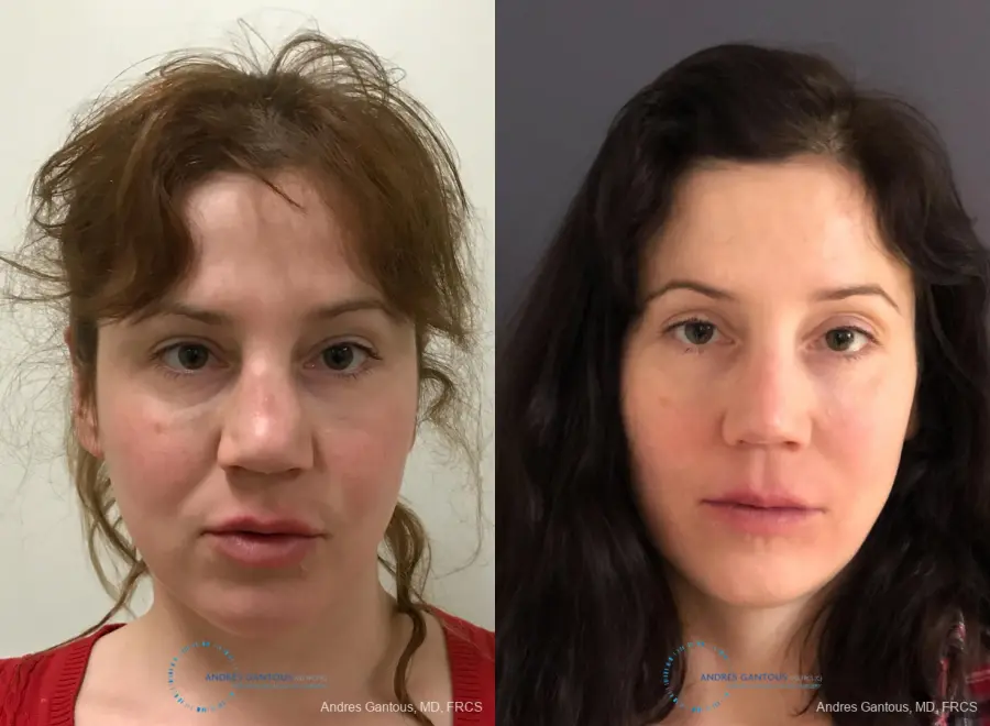 Revision Rhinoplasty: Patient 9 - Before and After  