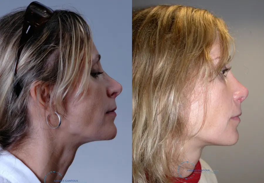 Revision Rhinoplasty: Patient 19 - Before and After 3