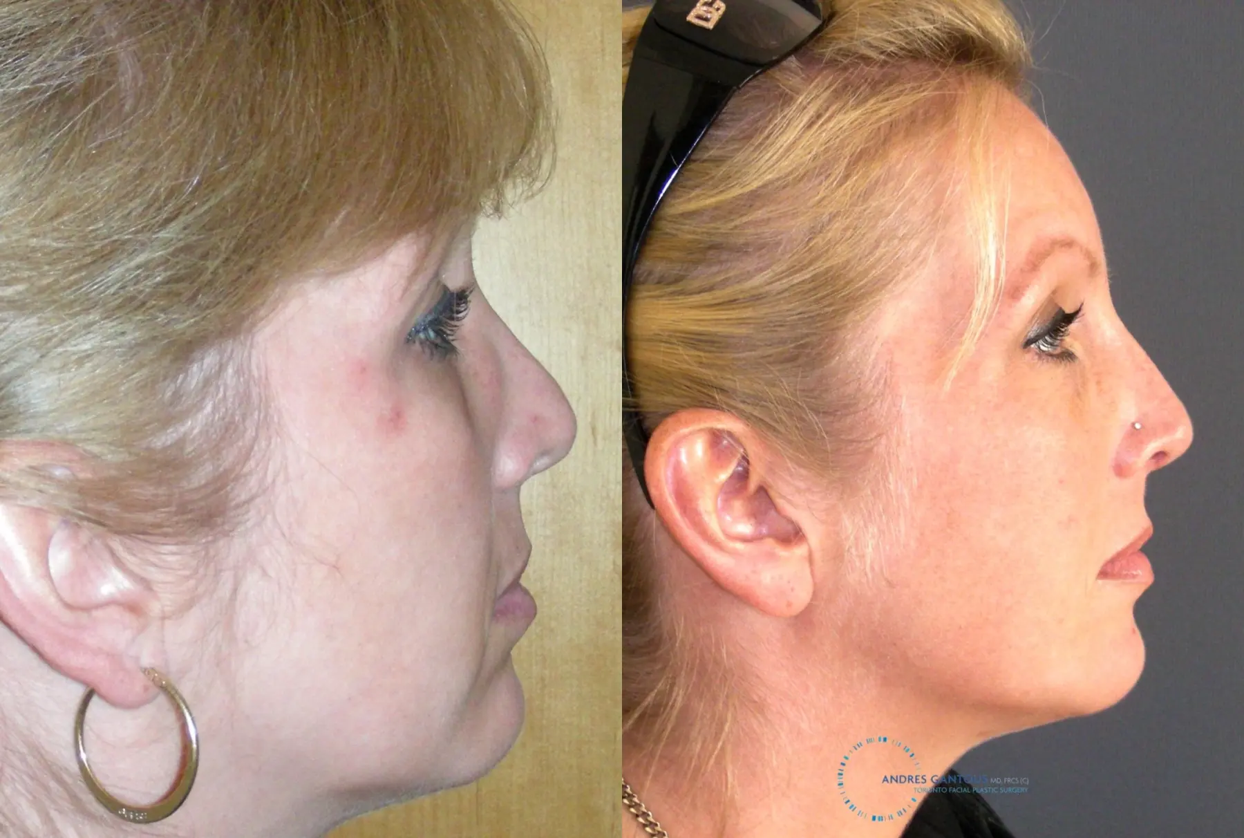 Revision Rhinoplasty: Patient 16 - Before and After 5