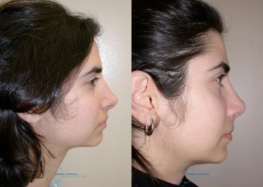 Revision Rhinoplasty: Patient 15 - Before and After 6