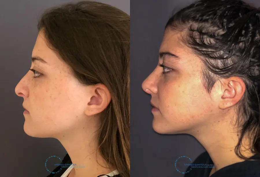 Revision Rhinoplasty: Patient 21 - Before and After 5