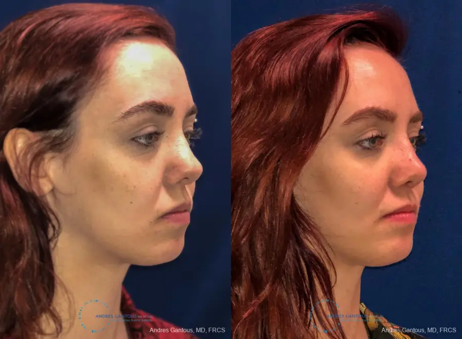 Revision Rhinoplasty: Patient 10 - Before and After 4