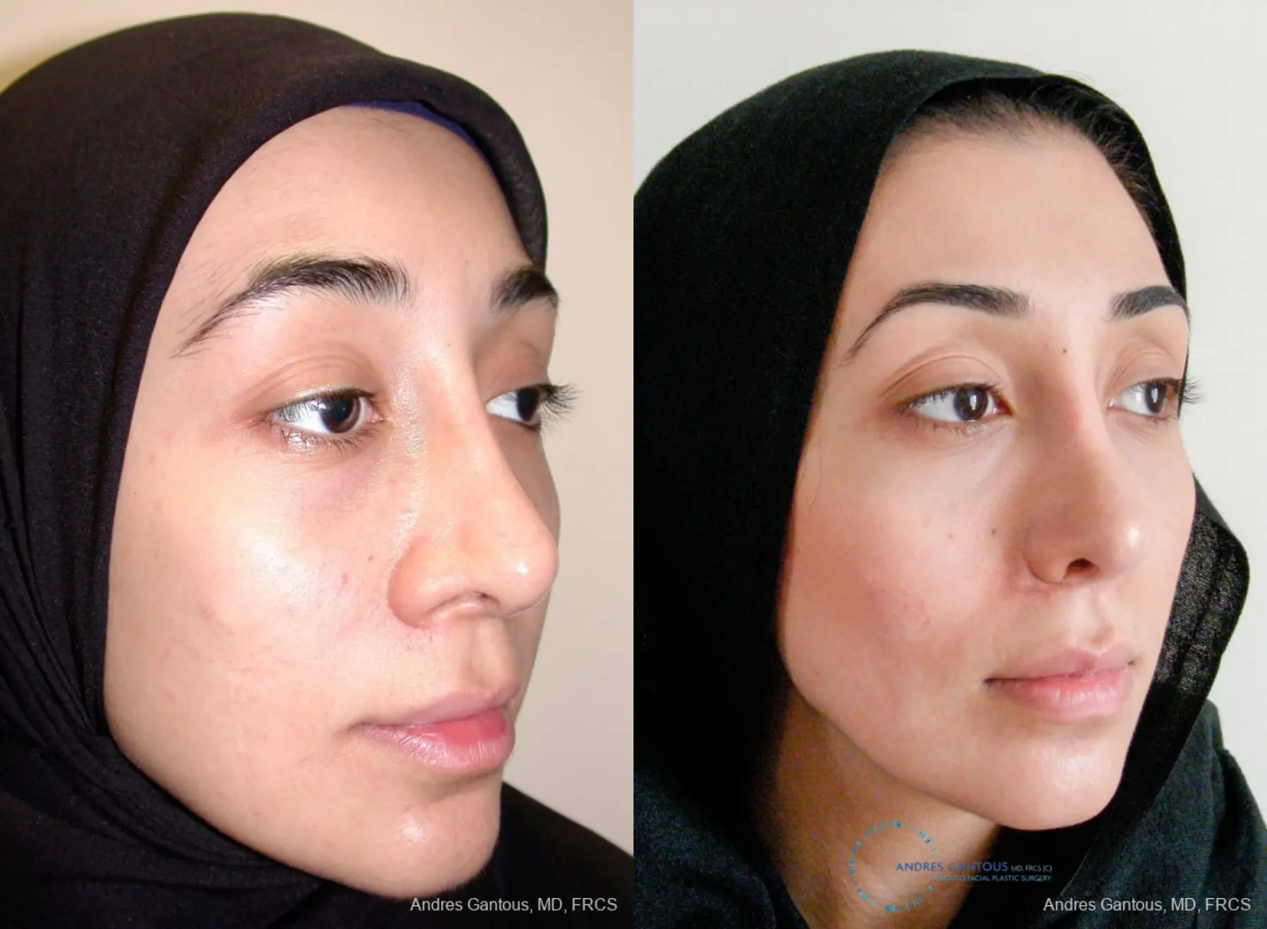 Revision Rhinoplasty: Patient 5 - Before and After 3