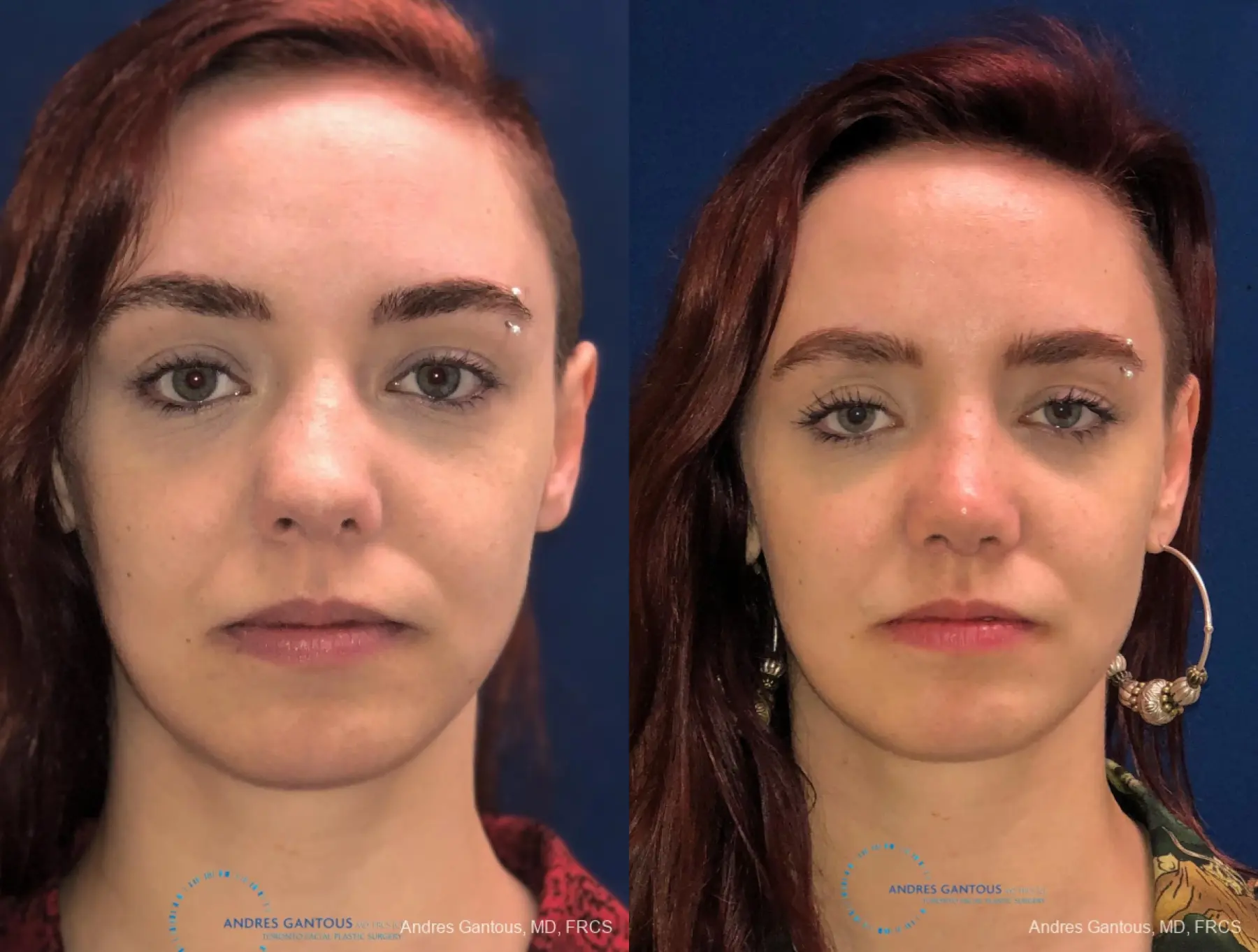 Revision Rhinoplasty: Patient 10 - Before and After 1
