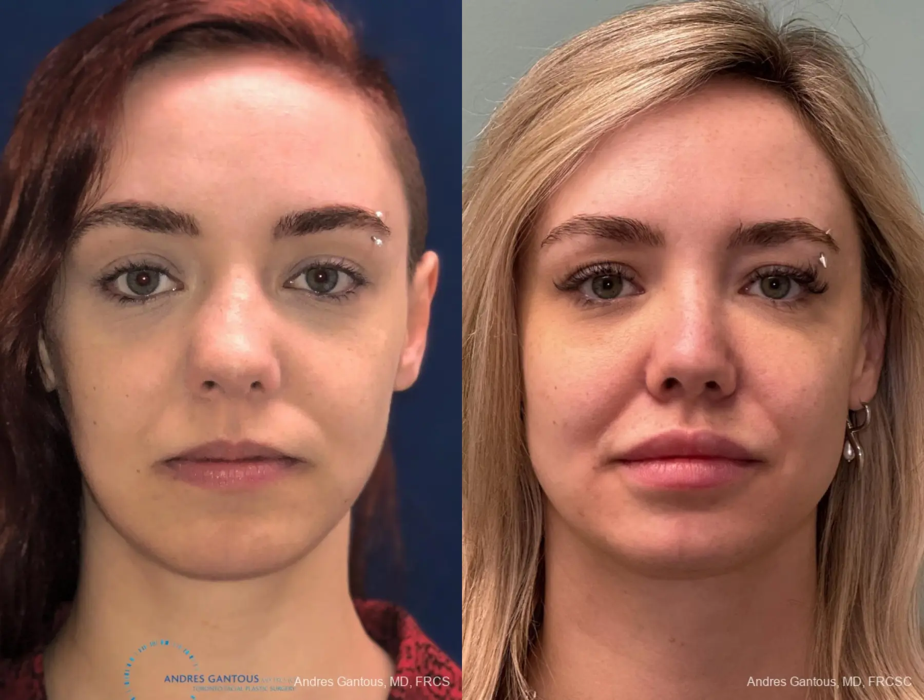 Revision Rhinoplasty: Patient 10 - Before and After  