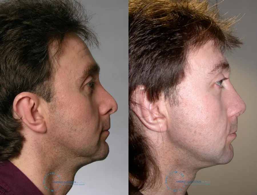 Revision Rhinoplasty: Patient 20 - Before and After 3