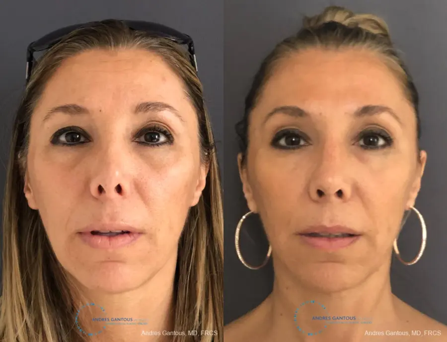 Revision Rhinoplasty: Patient 3 - Before and After 1