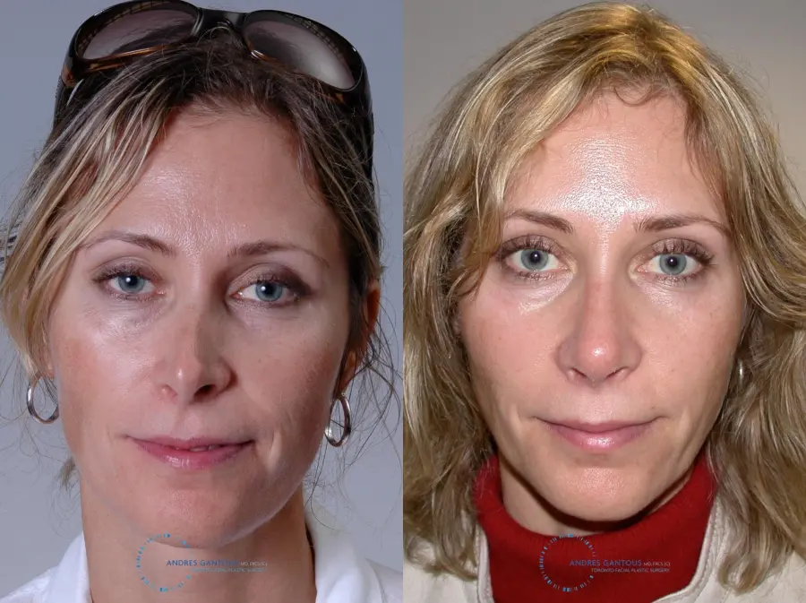 Revision Rhinoplasty: Patient 19 - Before and After 1