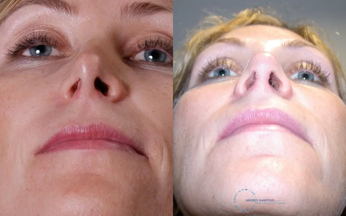 Revision Rhinoplasty: Patient 19 - Before and After 2