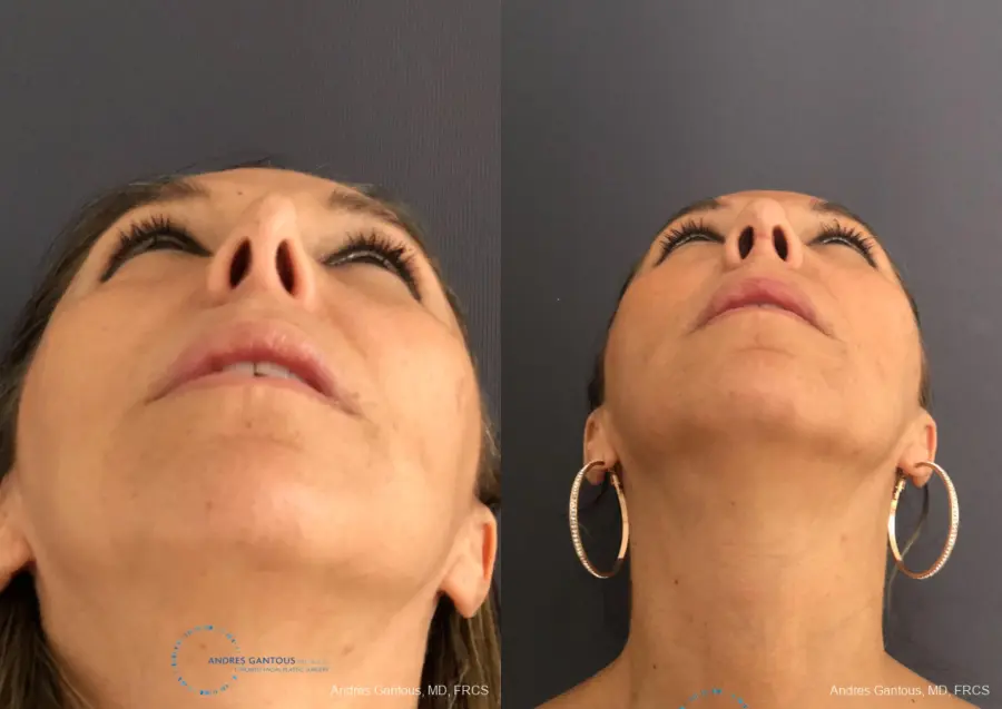 Revision Rhinoplasty: Patient 3 - Before and After 2