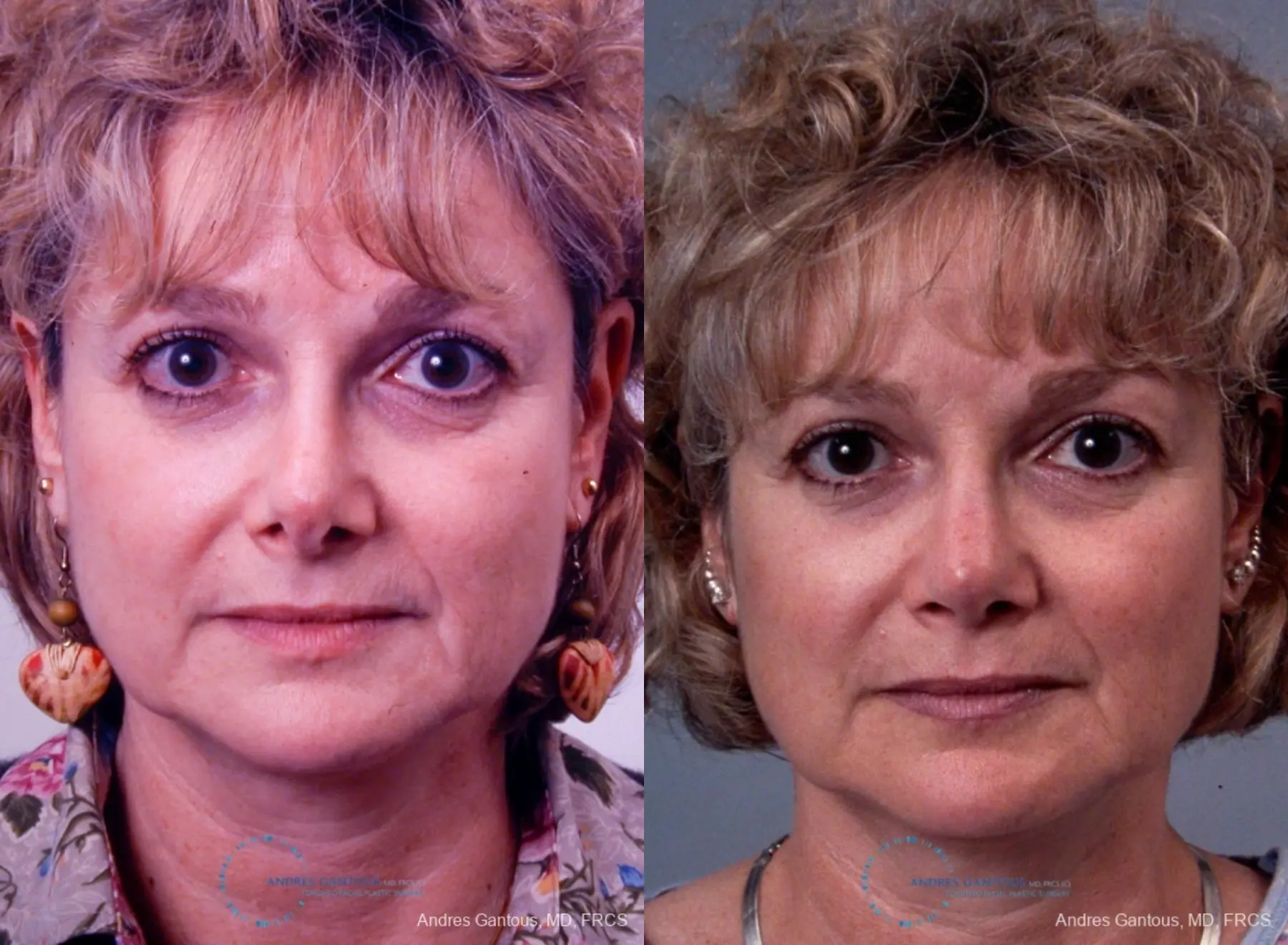 Revision Rhinoplasty: Patient 8 - Before and After  
