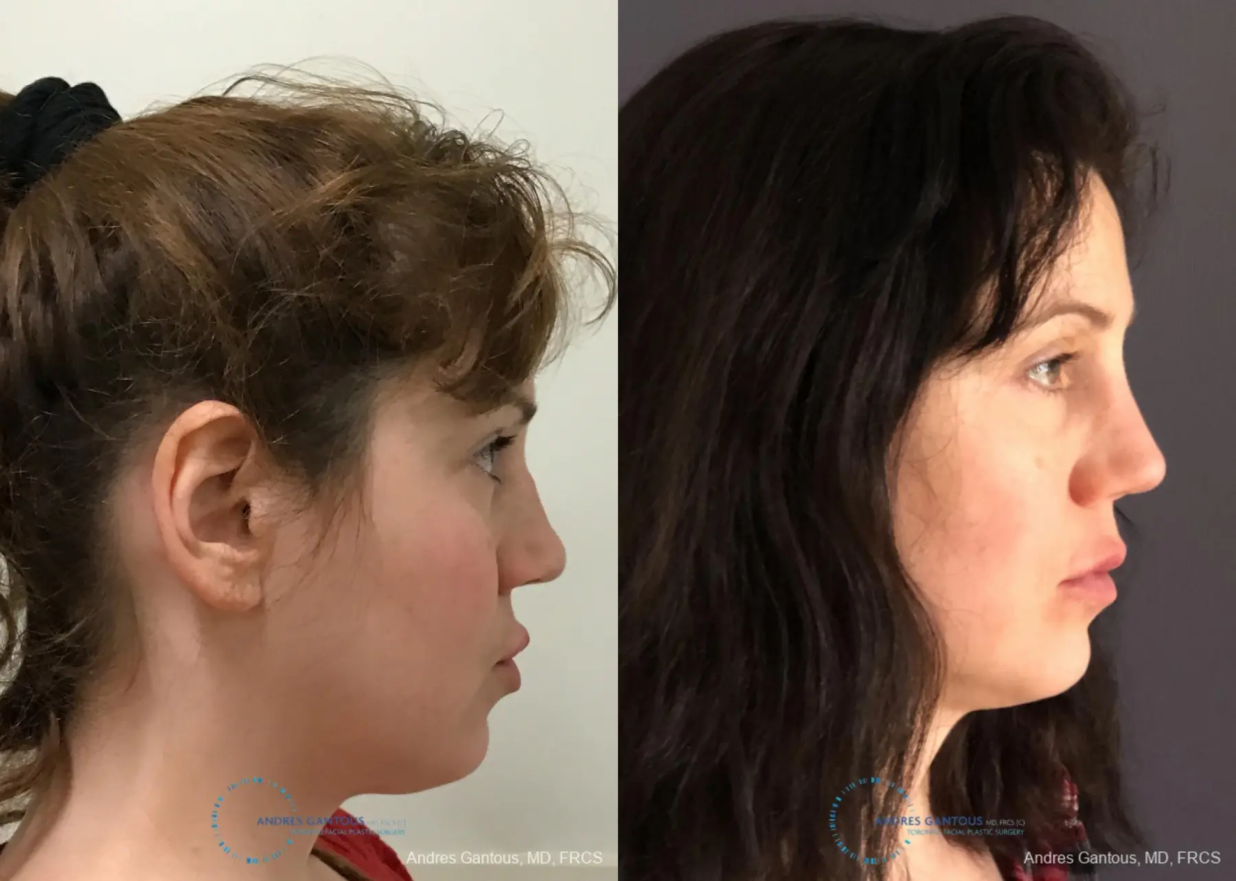 Revision Rhinoplasty: Patient 9 - Before and After 5