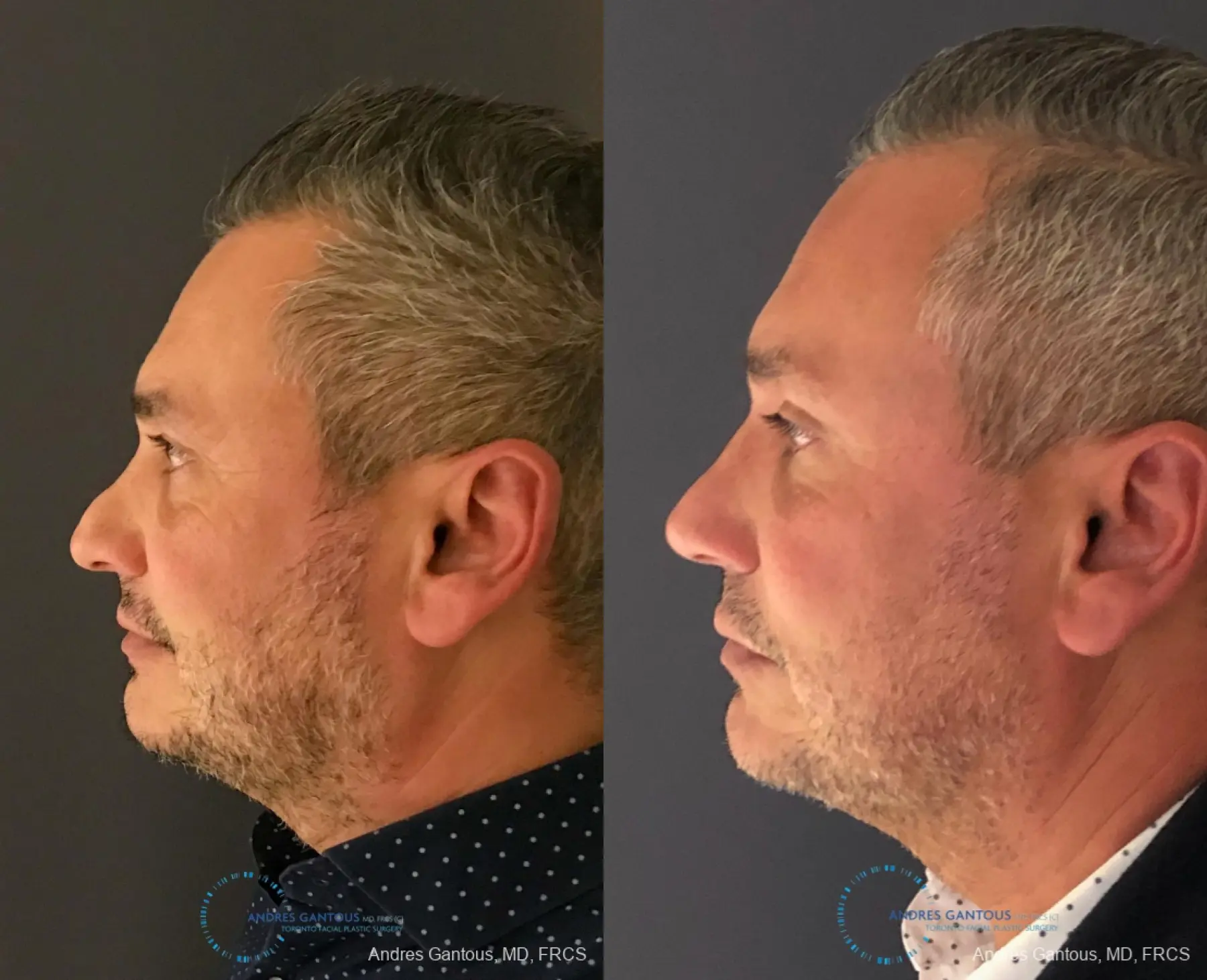 Revision Rhinoplasty: Patient 7 - Before and After 5