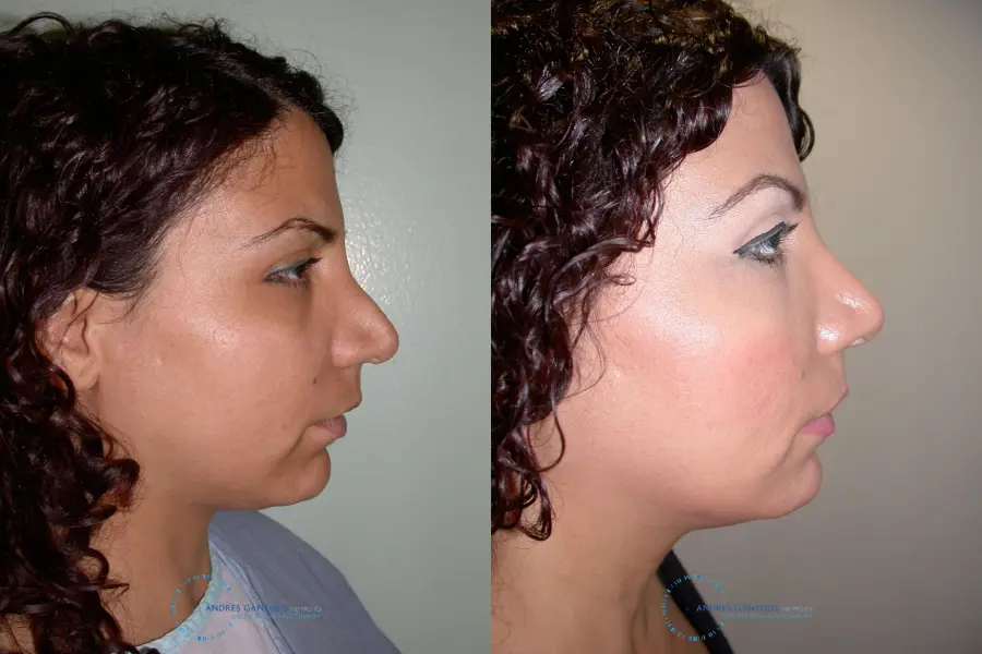 Revision Rhinoplasty: Patient 12 - Before and After 5