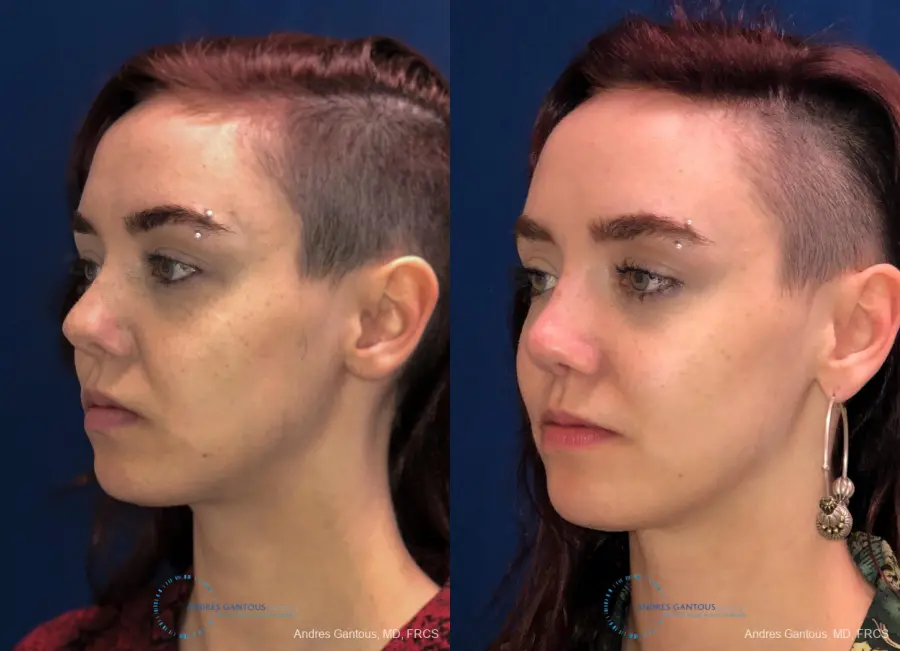 Revision Rhinoplasty: Patient 10 - Before and After 3