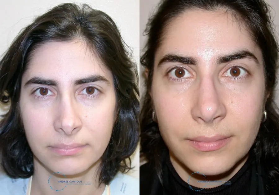 Revision Rhinoplasty: Patient 15 - Before and After 1
