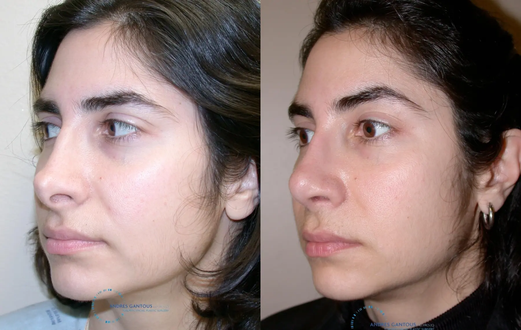 Revision Rhinoplasty: Patient 15 - Before and After 3