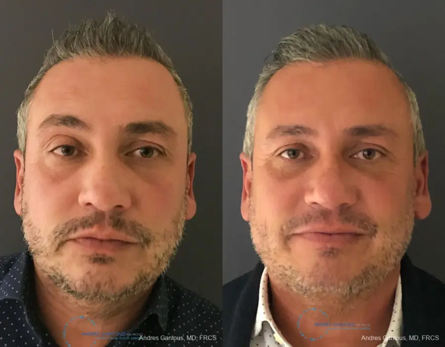 Revision Rhinoplasty: Patient 7 - Before and After 1
