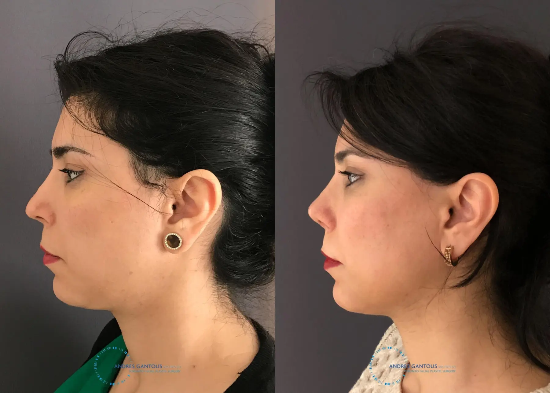 Revision Rhinoplasty: Patient 18 - Before and After 6