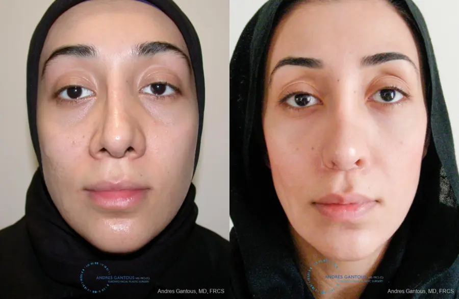 Revision Rhinoplasty: Patient 5 - Before and After 1
