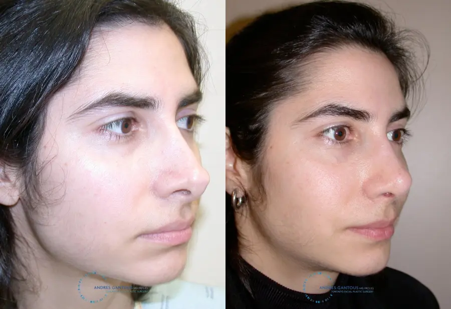 Revision Rhinoplasty: Patient 15 - Before and After 4
