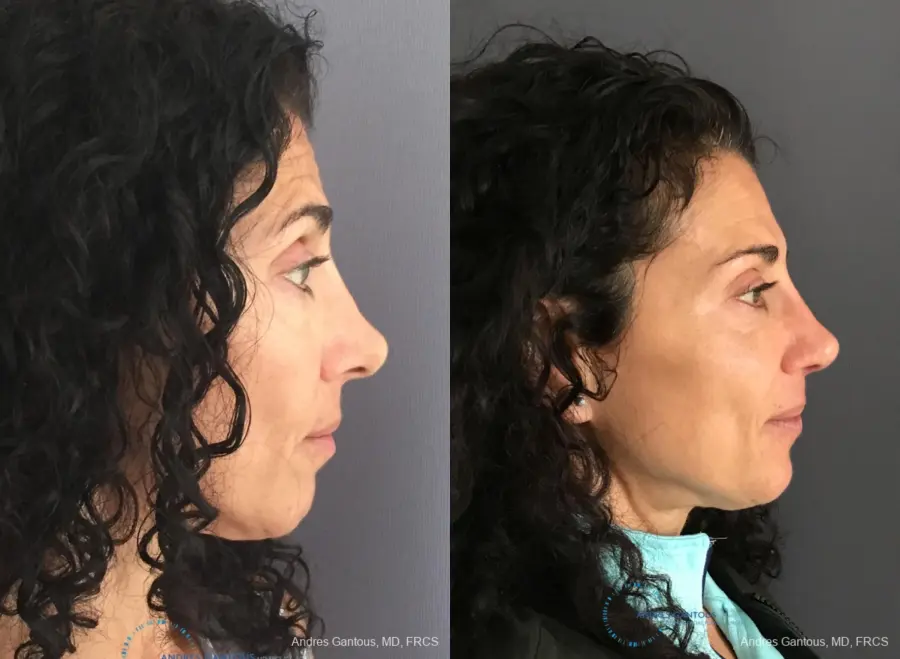 Revision Rhinoplasty: Patient 6 - Before and After 6