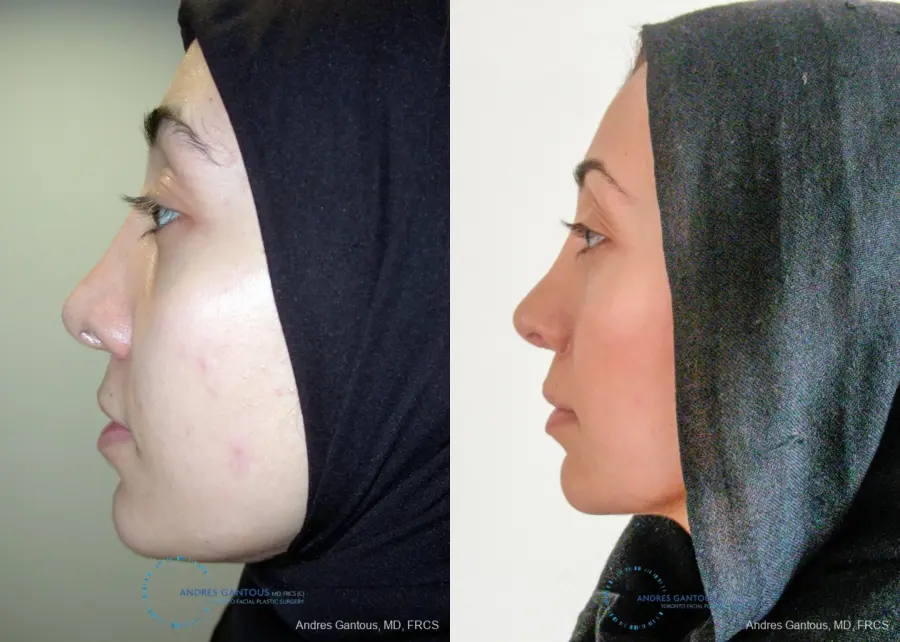 Revision Rhinoplasty: Patient 5 - Before and After 6