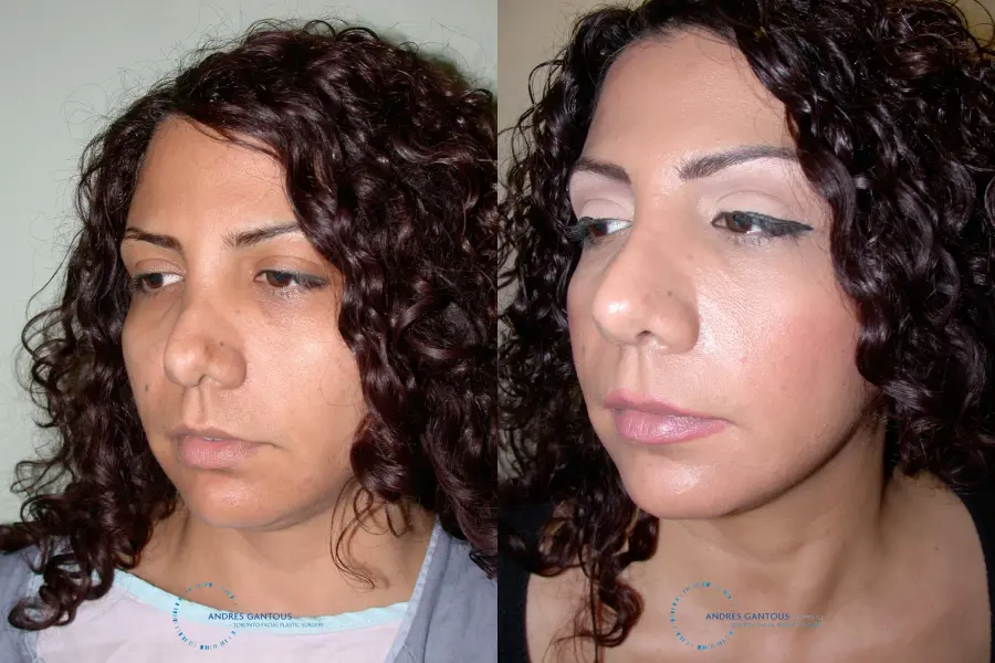 Revision Rhinoplasty: Patient 12 - Before and After 4