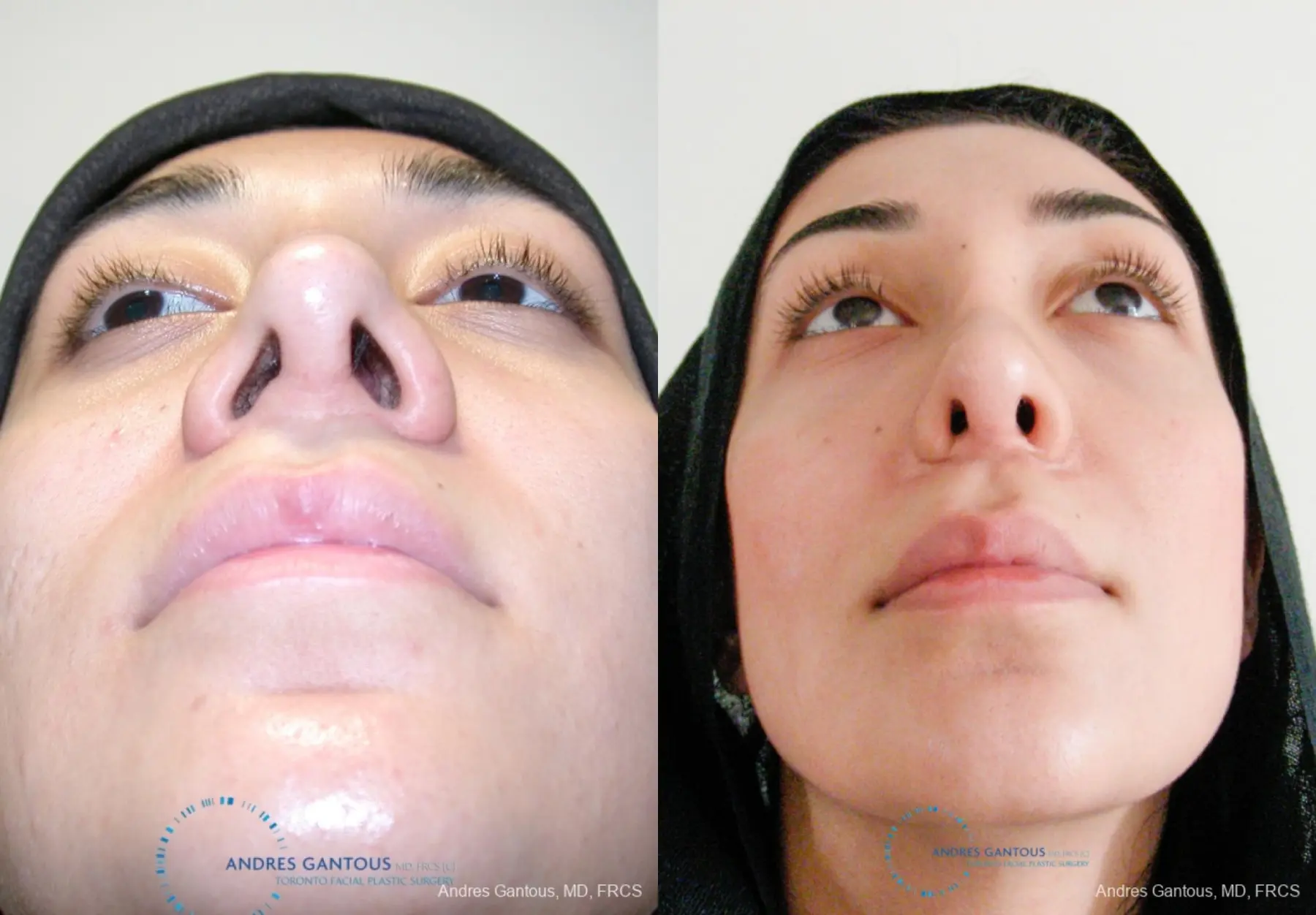 Revision Rhinoplasty: Patient 5 - Before and After 2