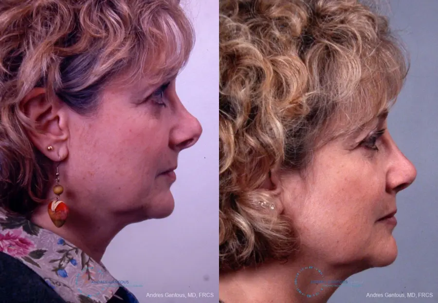 Revision Rhinoplasty: Patient 8 - Before and After 5