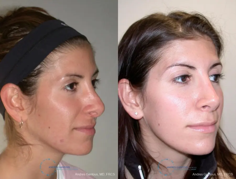 Revision Rhinoplasty: Patient 1 - Before and After 2